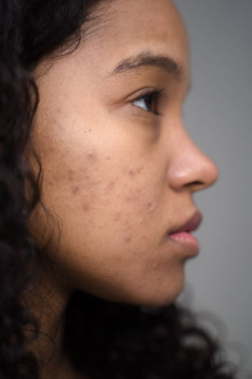 Does Sunscreen Cause Acne? How to Choose One That Won't Break You Out